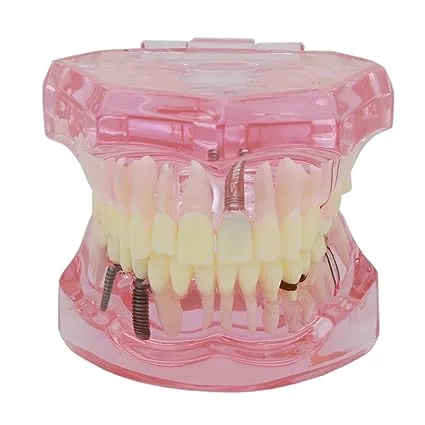 Teeth Model Teeth Typodonts Dental Implant Study Analysis Demonstration Teeth Model #2001 with Restoration Pink